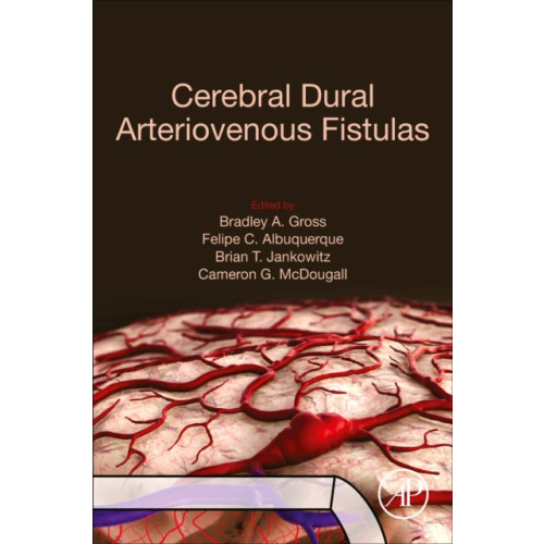 Elsevier Science Publishing Co Inc Cerebral Dural Arteriovenous Fistulas (häftad, eng)