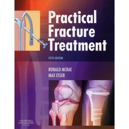 Elsevier Health Sciences Practical Fracture Treatment (häftad, eng)