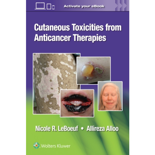 Wolters Kluwer Health Cutaneous Toxicities from Anticancer Therapies (häftad, eng)