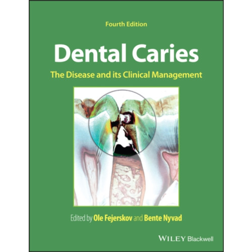 John Wiley And Sons Ltd Dental Caries (inbunden, eng)