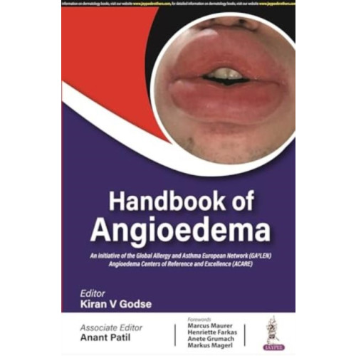 Jaypee Brothers Medical Publishers Handbook of Angioedema (häftad, eng)