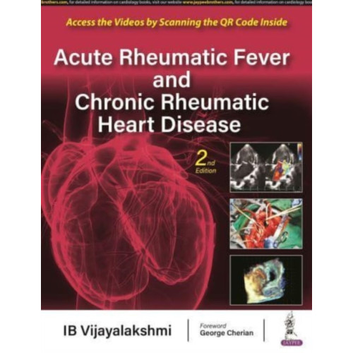 Jaypee Brothers Medical Publishers Acute Rheumatic Fever and Chronic Rheumatic Heart Disease (inbunden, eng)