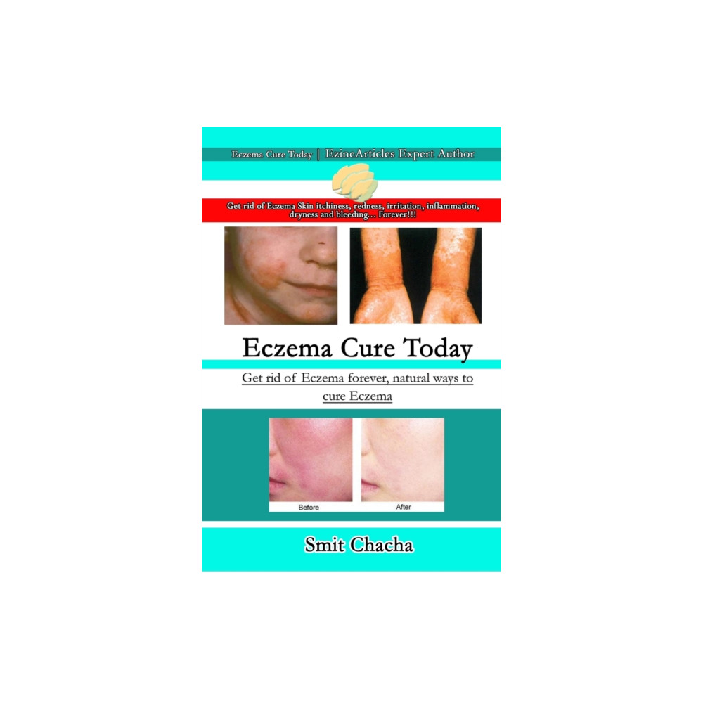 Produktbild för Eczema Cure Today - Get rid of Eczema forever natural ways to cure Eczema (häftad, eng)