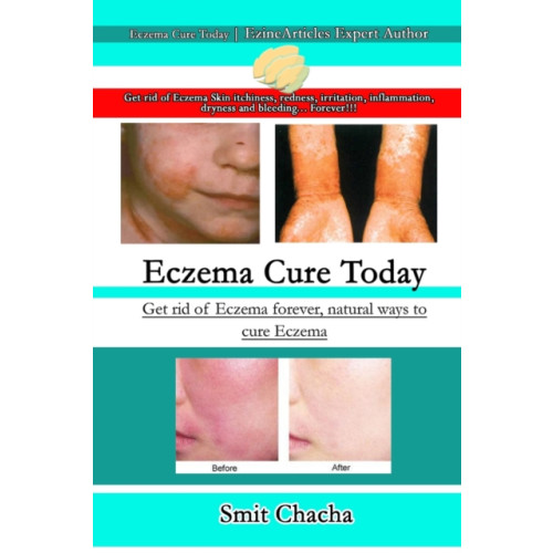 Lulu.com Eczema Cure Today - Get rid of Eczema forever natural ways to cure Eczema (häftad, eng)